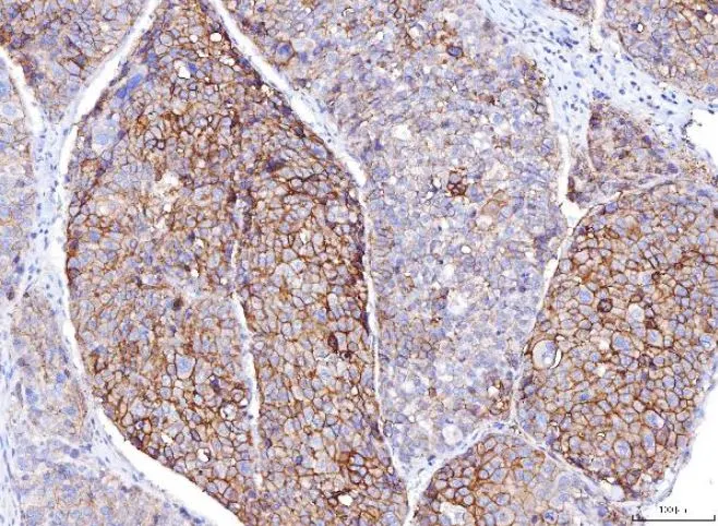 IHC-P analysis of human liver cancer tissue using GTX04249 CD155 antibody [5I13D1]. Antigen retrieval : Heat mediated antigen retrieval was performed in EDTA buffer (pH 8.0, epitope retrieval solution) Dilution : 2 microg/mL