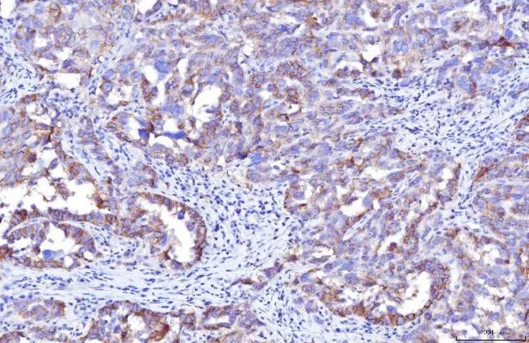 IHC-P analysis of human ovarian cancer tissue using GTX04249 CD155 antibody [5I13D1]. Antigen retrieval : Heat mediated antigen retrieval was performed in EDTA buffer (pH 8.0, epitope retrieval solution) Dilution : 2 microg/mL