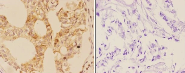 IHC-P analysis of human breast carcinoma tissue using GTX04258 AIRE antibody. Left : Primary antibody Right : Secondary antibody only Dilution : 1:50