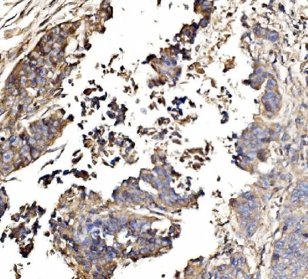 IHC-P analysis of human lung cancer tissue using GTX04318 GNAL antibody. Dilution : 2 microg/ml Antigen retrieval : Heat mediated antigen retrieval was performed in EDTA buffer (pH 8.0, epitope retrieval solution)