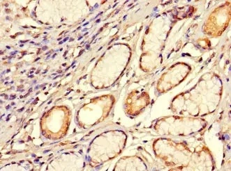 IHC-P analysis of human gastric cancer tissue using GTX04320 SMOC1 antibody. Dilution : 1:100