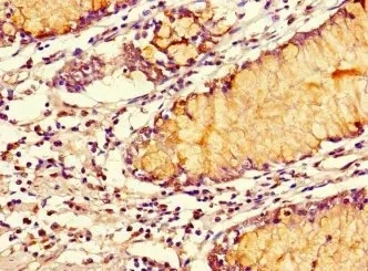 IHC-P analysis of human colon cancer tissue using GTX04320 SMOC1 antibody. Dilution : 1:100