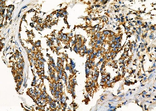 IHC-P analysis of human ovarian cancer tissue using GTX04322 WNK3 antibody. Antigen retrieval : Heat mediated antigen retrieval step in citrate buffer was performed. Dilution : 1:100