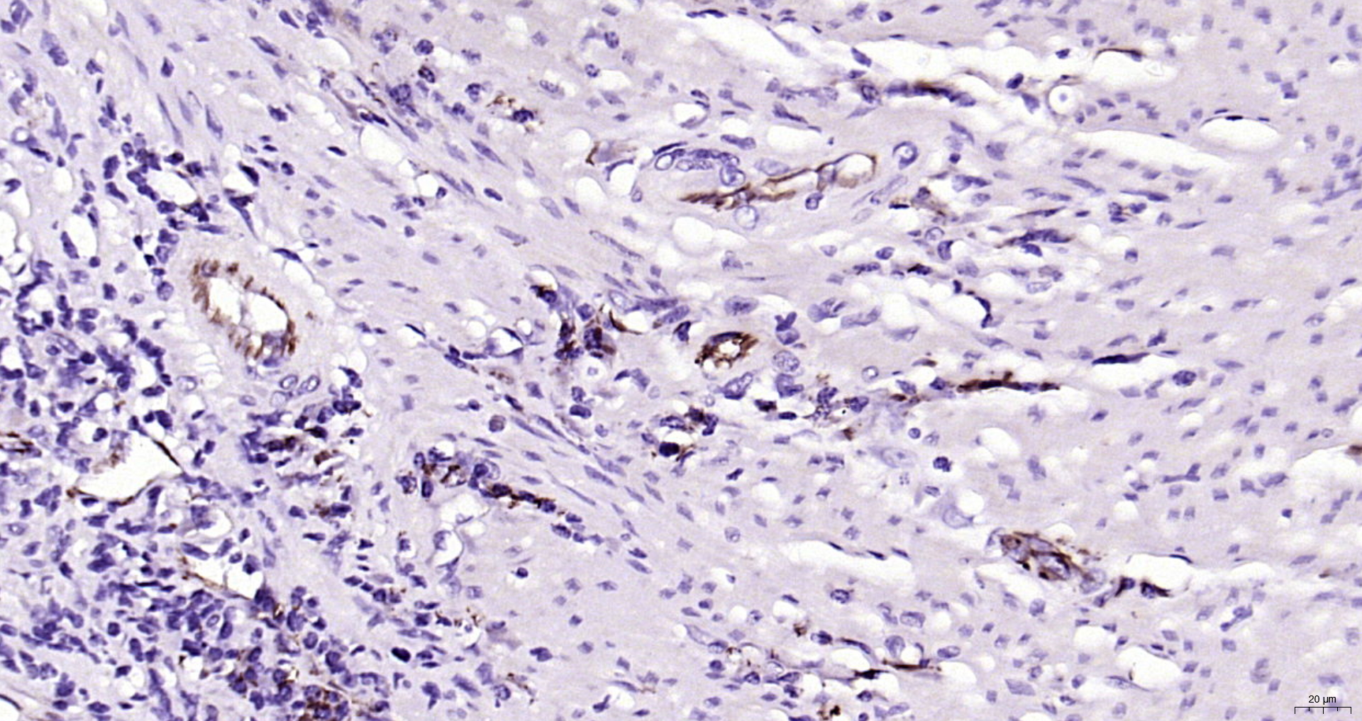 IHC-P analysis of human colon cancer tissue using GTX04325 CD31 antibody. Antigen retrieval : Boiling in sodium citrate buffer (pH6.0) for 15min Dilution : 1:200