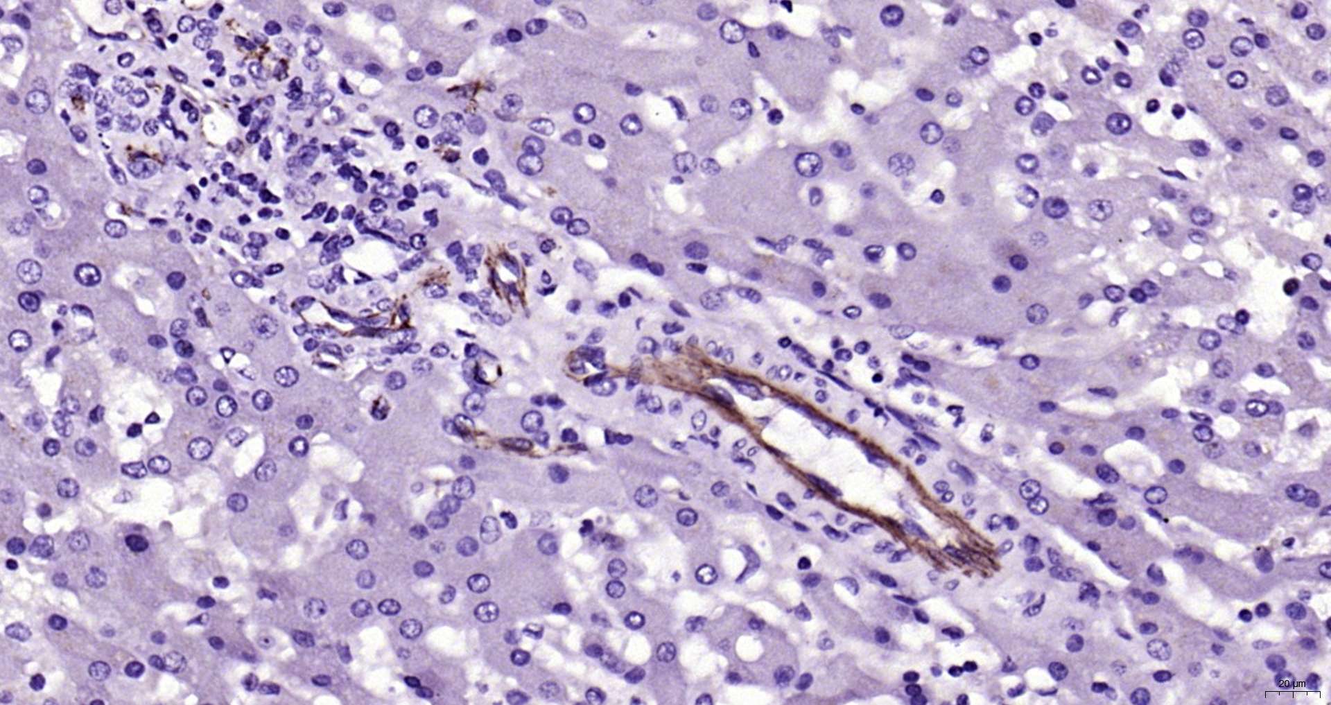 IHC-P analysis of human liver tissue using GTX04325 CD31 antibody. Antigen retrieval : Boiling in sodium citrate buffer (pH6.0) for 15min Dilution : 1:200