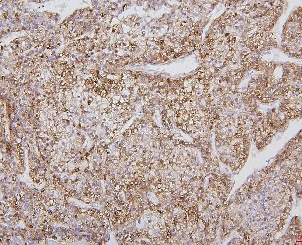 IHC-P analysis of human liver cancer tissue using GTX04494 CYP2E1 antibody. Antigen retrieval : Heat mediated citrate buffer (pH6.0) Dilution : 1microg/ml