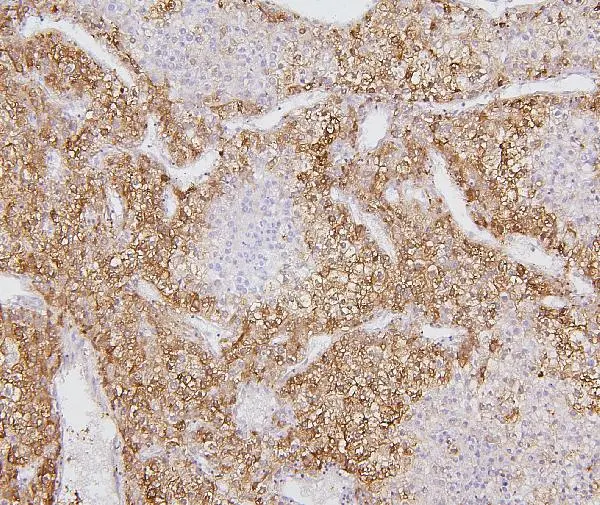 IHC-P analysis of human liver cancer tissue using GTX04494 CYP2E1 antibody. Antigen retrieval : Heat mediated citrate buffer (pH6.0) Dilution : 1microg/ml