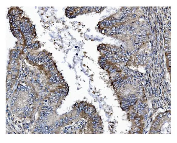 IHC-P analysis of human cervical intraepithelial neoplasia tissue using GTX04538 Gasdermin D antibody [6D11]. Antigen retrieval : Heat mediated EDTA buffer (pH 8.0) Dilution : 2 microg/mL