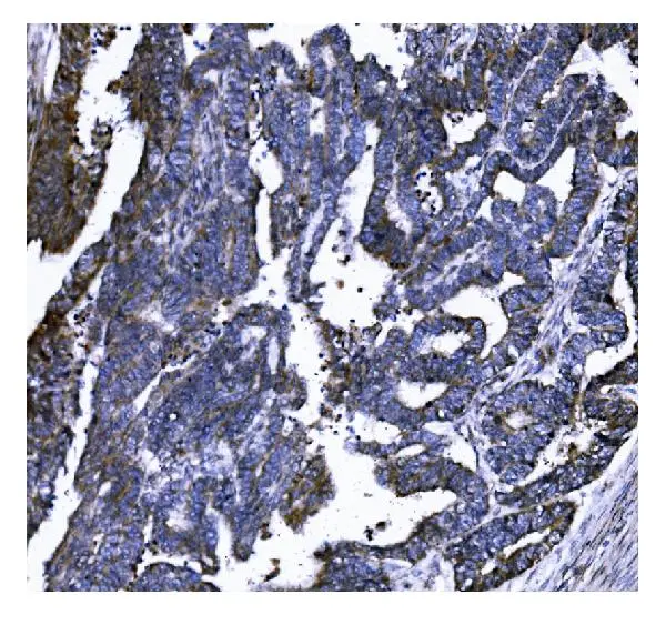 IHC-P analysis of human cervical cancern tissue using GTX04538 Gasdermin D antibody [6D11]. Antigen retrieval : Heat mediated EDTA buffer (pH 8.0) Dilution : 2 microg/mL