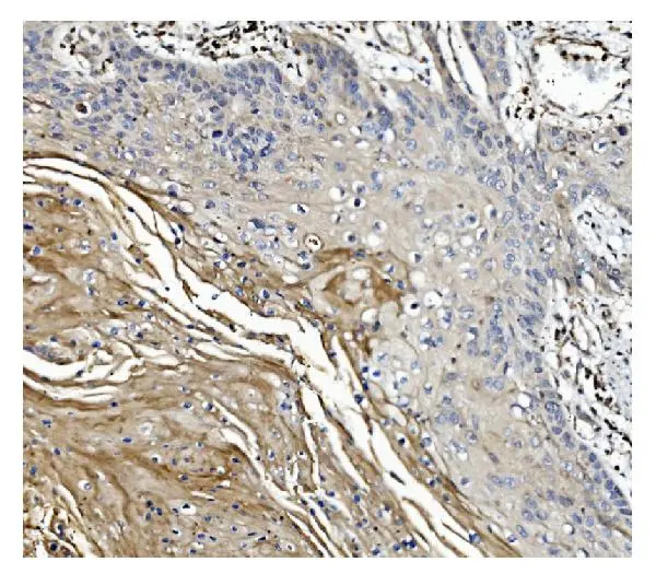 IHC-P analysis of human esophageal squamous carcinoma tissue using GTX04538 Gasdermin D antibody [6D11]. Antigen retrieval : Heat mediated EDTA buffer (pH 8.0) Dilution : 2 microg/mL