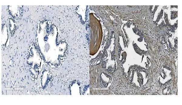 IHC-P analysis of human prostate cancer tissue using GTX04544 CDH11 antibody. Antigen retrieval : Heat mediated EDTA buffer (pH8.0) Dilution : 2 microg/mL