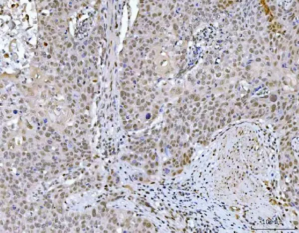 IHC-P analysis of human esophageal squamous carcinoma tissue using GTX04548 GLIS1 antibody. Antigen retrieval : Heat mediated EDTA buffer (pH8.0) Dilution : 2 microg/mL