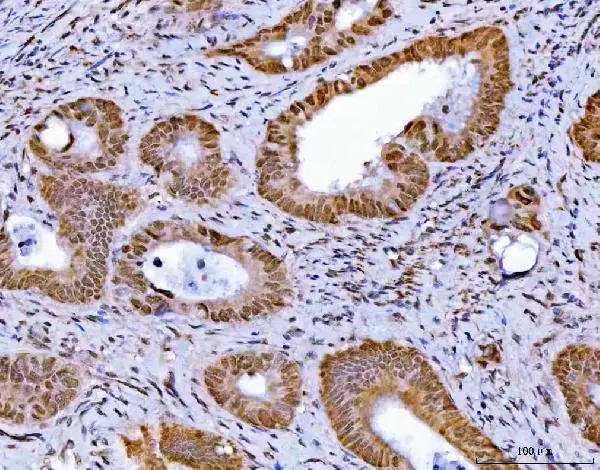 IHC-P analysis of human colorectal adenocarcinoma tissue using GTX04548 GLIS1 antibody. Antigen retrieval : Heat mediated EDTA buffer (pH8.0) Dilution : 2 microg/mL