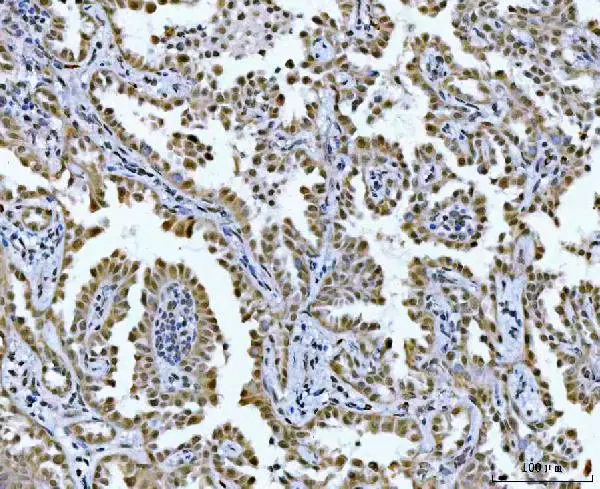 IHC-P analysis of human lung cancer tissue using GTX04548 GLIS1 antibody. Antigen retrieval : Heat mediated EDTA buffer (pH8.0) Dilution : 2 microg/mL
