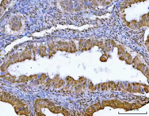 IHC-P analysis of human ovarian cancer tissue using GTX04548 GLIS1 antibody. Antigen retrieval : Heat mediated EDTA buffer (pH8.0) Dilution : 2 microg/mL