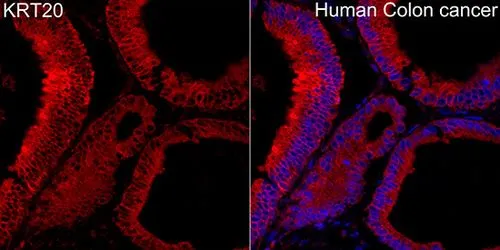 IHC-P analysis of human colon carcinoma tissue using GTX04562 Cytokeratin 20 antibody. Orange : Primary antibody Blue : DAPI Dilution : 1:100 IHC-P analysis of human colon carcinoma tissue using GTX04562 Cytokeratin 20 antibody. Orange : Primary antibody Blue : DAPI Dilution : 1:100