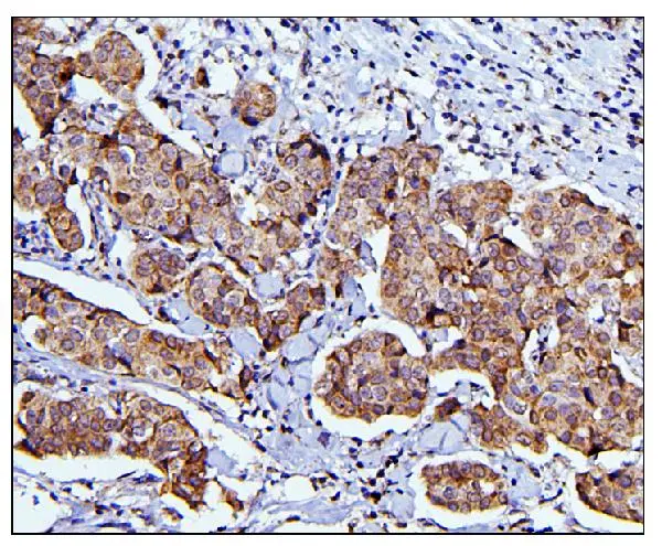 IHC-P analysis of human mammary cancer tissue using GTX04584 CDC42 antibody. Antigen retrieval : Heat mediated EDTA buffer (pH 8.0) Dilution : 1 microg/mL