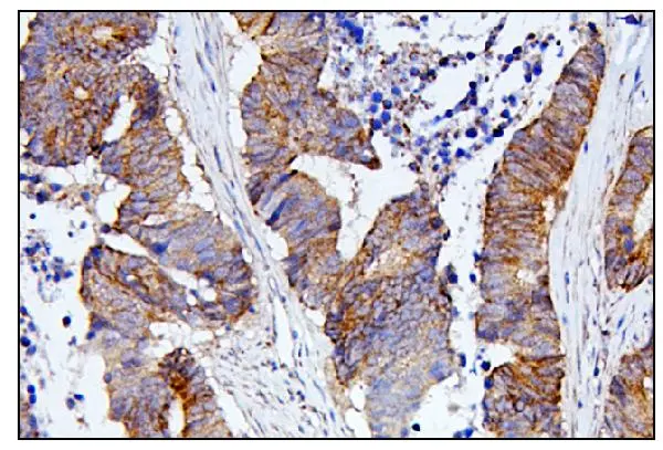 IHC-P analysis of human colon cancer tissue using GTX04584 CDC42 antibody. Antigen retrieval : Heat mediated EDTA buffer (pH 8.0) Dilution : 1 microg/mL