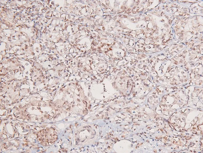 IHC-P analysis of human liver cancer tissue using GTX04588 GCN2 (phospho Thr899) antibody. Antigen retrieval : Heat mediated citrate buffer Dilution : 1:200