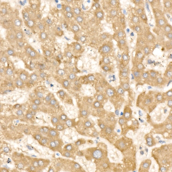 IHC-P analysis of human liver tissue using GTX04607 YKL-39 antibody. Antigen retrieval : 10 mM citrate buffer pH6.0 Dilution : 1:100 IHC-P analysis of human liver tissue using GTX04607 YKL-39 antibody. Antigen retrieval : 10 mM citrate buffer pH6.0 Dilution : 1:100