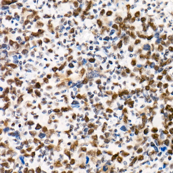 IHC-P analysis of human undifferentiated carcinoma of esophagus tissue using GTX04623 SNF5 antibody [ARC53139]. Antigen retrieval : 10 mM Tris/EDTA buffer pH 9.0 Dilution : 1:100