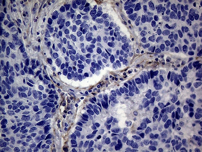 IHC-P analysis of human lung carcinoma tissue using GTX04688 PMP22 antibody [OTI5D1]. Antigen retrieval : Heat mediated 1mM EDTA in 10mM Tris buffer (pH 8.5) Dilution : 1:2000