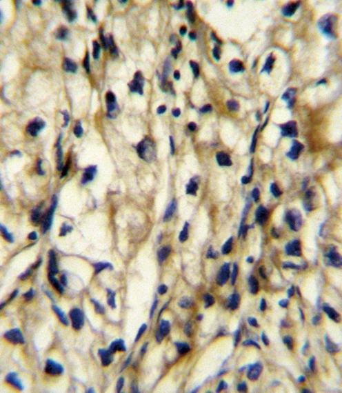 IHC-P analysis of human kidney carcinoma tissus using GTX04695 BCAT1 antibody. IHC-P analysis of human kidney carcinoma tissus using GTX04695 BCAT1 antibody.