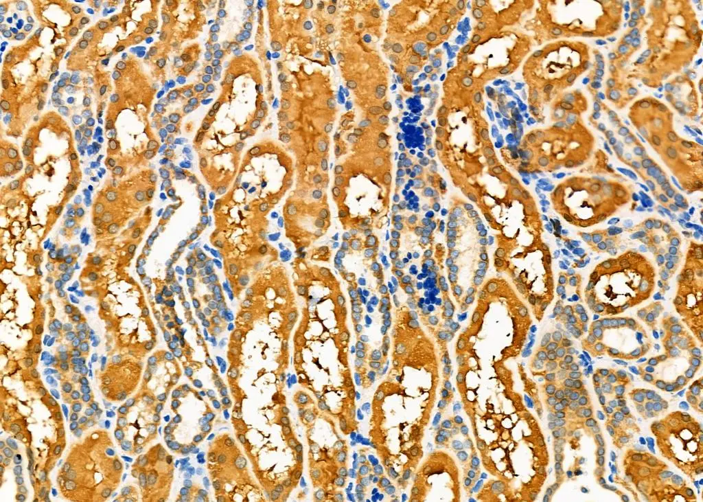 IHC-P analysis of human kidney cancer and adjacent normal tissue using GTX04729 Fc epsilon R1 alpha antibody. Antigen retrieval : Heat mediated citrate buffer Dilution : 1:100
