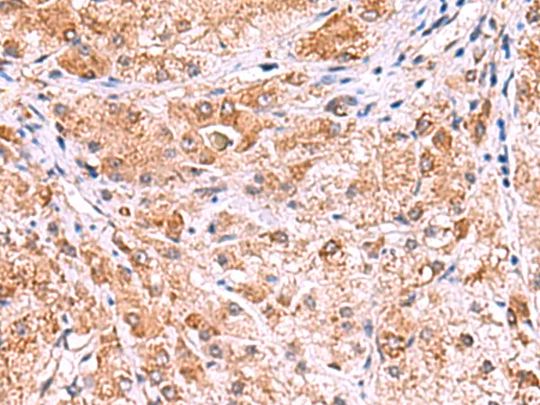 IHC-P analysis of human liver cancer tissue using GTX04750 UXS1 antibody. Dilution : 1:60