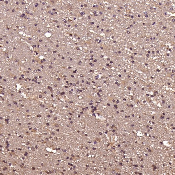 IHC-P analysis of human glioblastoma tissue using GTX04753 EGFR antibody [AEF-5]. Dilution : 1:100