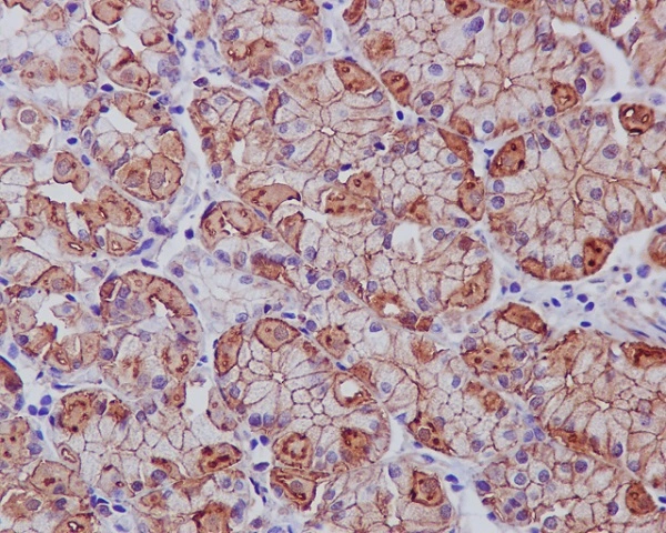 IHC-P analysis of human stomach cancer tissue using GTX04753 EGFR antibody [AEF-5].