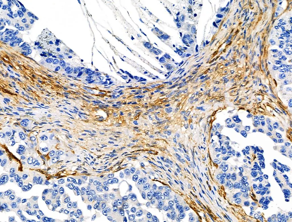IHC-P analysis of human lung cancer tissue using GTX04760 Transgelin antibody. Antigen retrieval : Heat mediated citrate buffer Dilution : 1:100