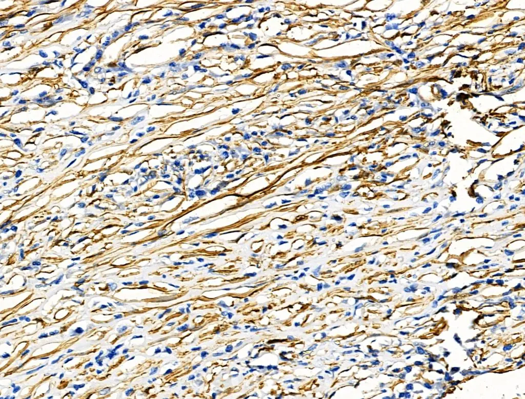 IHC-P analysis of human pancreatic cancer tissue using GTX04760 Transgelin antibody. Antigen retrieval : Heat mediated citrate buffer Dilution : 1:100