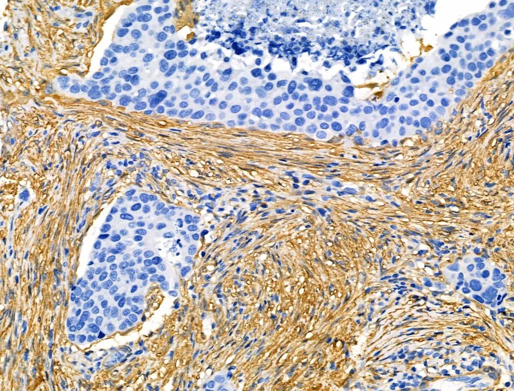 IHC-P analysis of human mammary cancer tissue using GTX04760 Transgelin antibody. Antigen retrieval : Heat mediated citrate buffer Dilution : 1:100