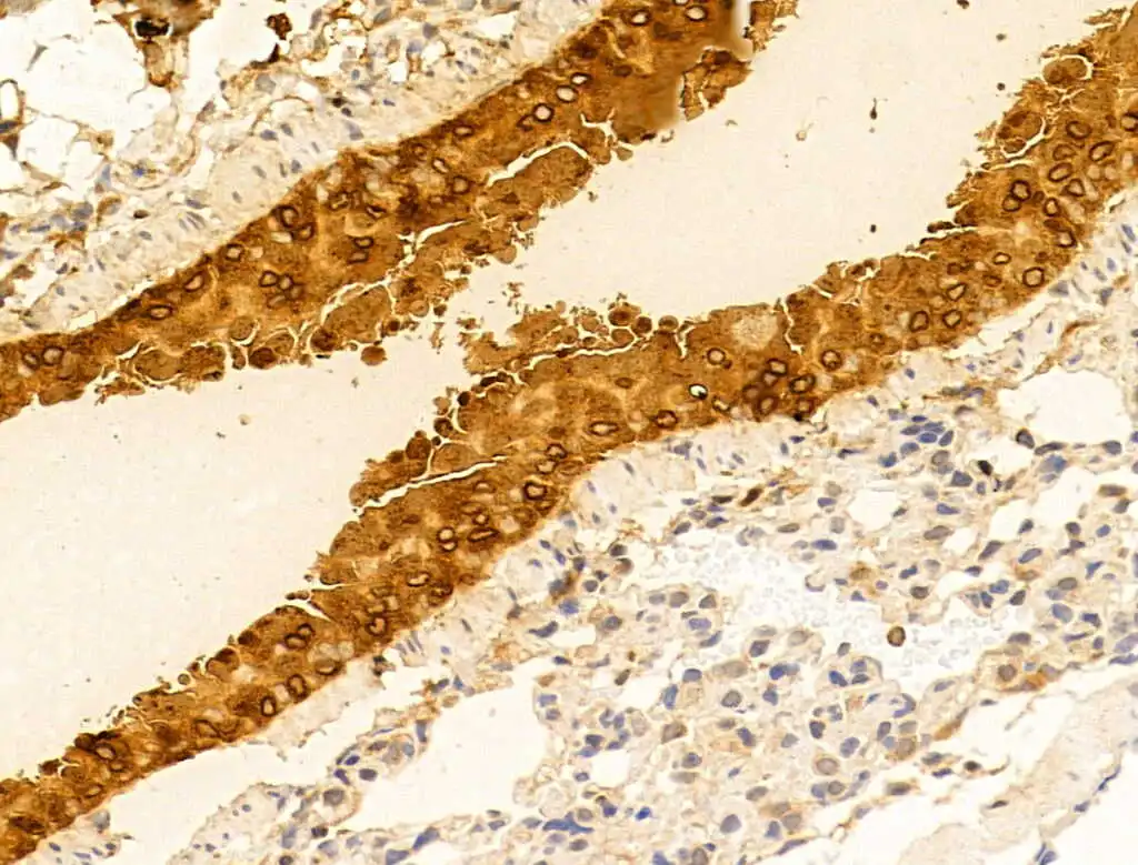 IHC-P analysis of mouse lung tissue using GTX04845 MMP13 antibody. Antigen retrieval : Heat mediated citrate buffer Dilution : 1:100 IHC-P analysis of mouse lung tissue using GTX04845 MMP13 antibody. Antigen retrieval : Heat mediated citrate buffer Dilution : 1:100