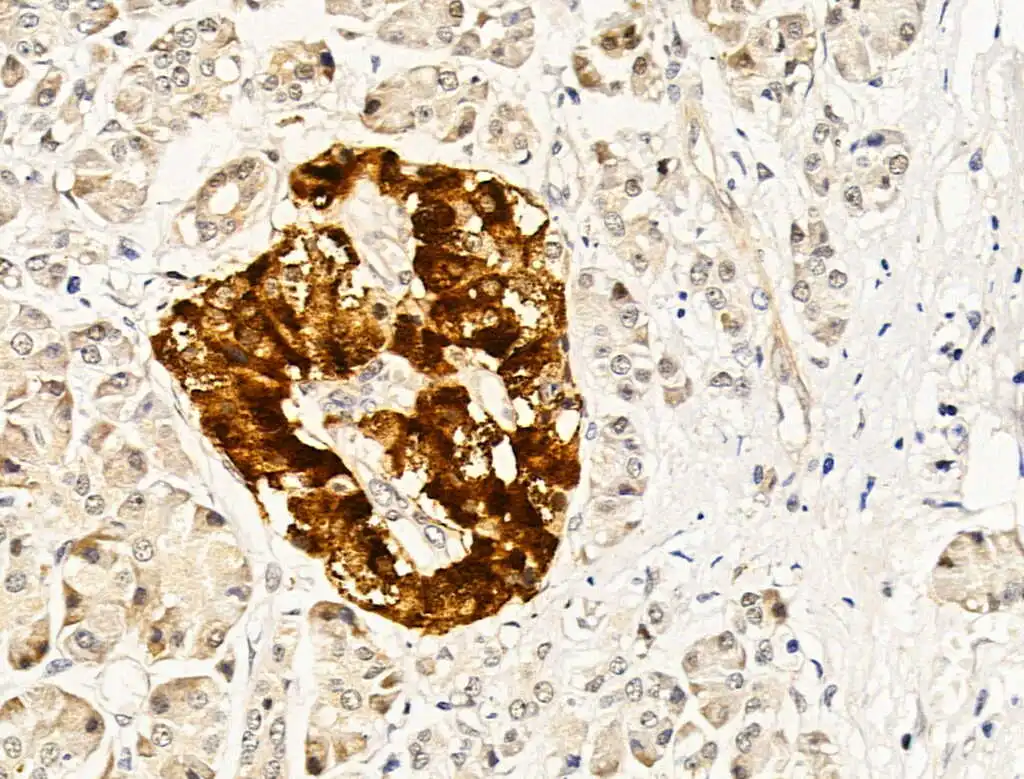 IHC-P analysis of human pancreatic cancer and adjacent normal tissues using GTX04845 MMP13 antibody. Antigen retrieval : Heat mediated citrate buffer Dilution : 1:100