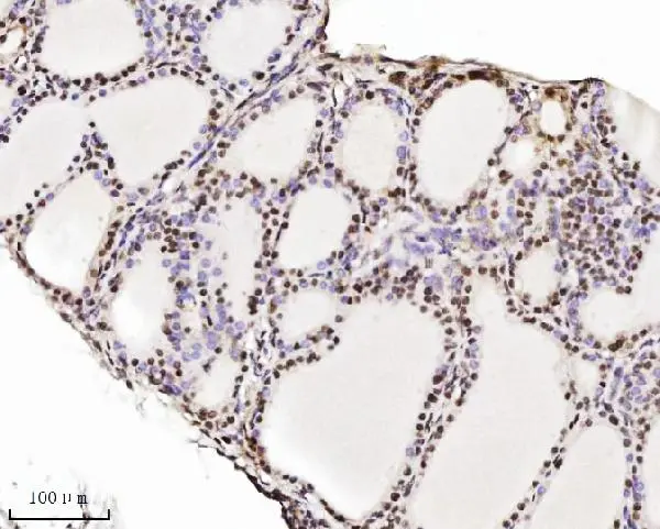 IHC-P analysis of human thyroid cancer tissue using GTX04912 TIF1 alpha antibody [4G6C2]. Antigen retrieval : Heat mediated EDTA buffer, pH 8.0 Dilution : 2 microg/ml