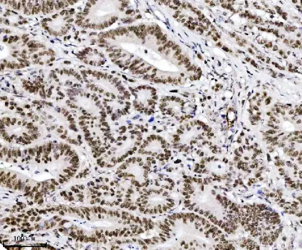 IHC-P analysis of human colon adenocarcinoma tissue using GTX04912 TIF1 alpha antibody [4G6C2]. Antigen retrieval : Heat mediated EDTA buffer, pH 8.0 Dilution : 2 microg/ml