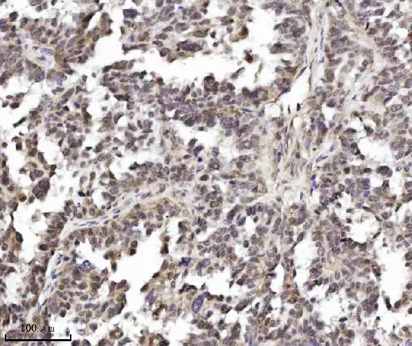 IHC-P analysis of human ovarian serous tumor tissue using GTX04912 TIF1 alpha antibody [4G6C2]. Antigen retrieval : Heat mediated EDTA buffer, pH 8.0 Dilution : 2 microg/ml