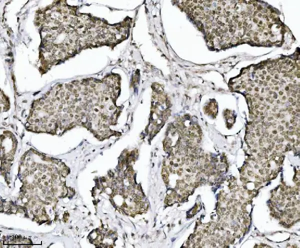 IHC-P analysis of human breast cancer tissue using GTX04912 TIF1 alpha antibody [4G6C2]. Antigen retrieval : Heat mediated EDTA buffer, pH 8.0 Dilution : 2 microg/ml