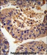 IHC-P analysis of human hepatocarcinoma tissue using GTX04936 AGXT antibody.