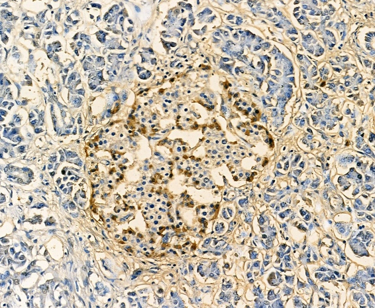 IHC-P analysis of human pancreas tissue using GTX04945 Glucagon antibody. Antigen retrieval : Heat mediation with citrate buffer. Dilution : 1: 100 IHC-P analysis of human pancreas tissue using GTX04945 Glucagon antibody. Antigen retrieval : Heat mediation with citrate buffer. Dilution : 1: 100