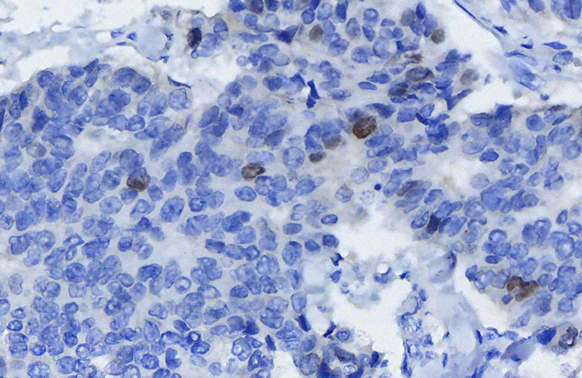 Survivin antibody detects Survivin protein at nucleus by immunohistochemical analysis (Autostainer Formulated). Sample: Paraffin-embedded human breast cancer. Survivin stained by Survivin antibody (GTX100052) diluted at 1:100. Antigen Retrieval: EDTA buffer, 30 min