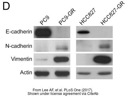 E-cadherin antibody detects E-cadherin protein at membrane on human breast cancer by immunohistochemical analysis.