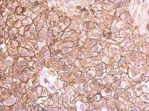 E-cadherin antibody detects E-cadherin protein at membrane on human breast cancer by immunohistochemical analysis.