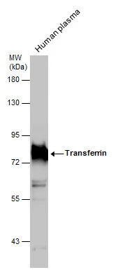 Transferrin antibody [N3C3] detects Transferrin protein at cytoplasm in human esophageal carcinoma by immunohistochemical analysis. Sample: Paraffin-embedded human esophageal carcinoma.