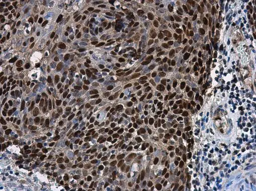 SOX2 antibody [N1C3] detects SOX2 protein at nucleus in human cervical carcinoma by immunohistochemical analysis. Sample: Paraffin-embedded human cervical carcinoma. SOX2 antibody [N1C3] (GTX101507) diluted at 1:500. 
 Antigen Retrieval: Citrate buffer, pH 6.0, 15 min