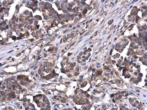 ATG5 antibody [N1C3] detects ATG5 protein at cytoplasm in human oral carcinoma by immunohistochemical analysis. Sample: Paraffin-embedded human oral carcinoma. ATG5 antibody [N1C3] (GTX102361) diluted at 1:500. 
 Antigen Retrieval: Citrate buffer, pH 6.0, 15 min