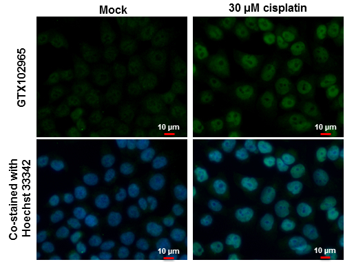 p53 antibody detects p53 protein at cytoplasm and nucleus by immunohistochemical analysis. Sample:Paraffin-embedded human breast carcinoma. p53 stained by p53 antibody (GTX102965) diluted at 1:500. Antigen Retrieval:Citrate buffer,pH 6.0,15 min