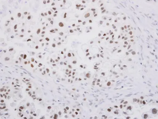 SP1 antibody detects SP1 protein at nucleus on human ovarian carcinoma by immunohistochemical analysis. Sample: Paraffin-embedded human ovarian carcinoma. SP1 antibody (GTX103031) diluted at 1:250.
Antigen Retrieval: Trilogy? (EDTA based, pH 8.0) buffer, 15min SP1 antibody detects SP1 protein at nucleus on human ovarian carcinoma by immunohistochemical analysis. Sample: Paraffin-embedded human ovarian carcinoma. SP1 antibody (GTX103031) diluted at 1:250.
Antigen Retrieval: Trilogy? (EDTA based, pH 8.0) buffer, 15min